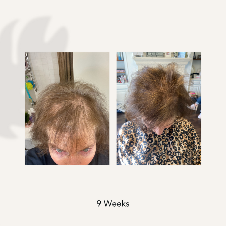 9 weeks before and after showing dramatically a reduced hair loss and thinning results from using Actiiv Recover Thickening Shampoo Treatment for Women