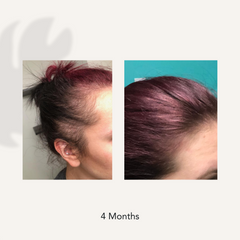 4 months before and after showing dramatically a reduced hair loss and thinning results from using Actiiv Recover Thickening Shampoo Treatment for Women